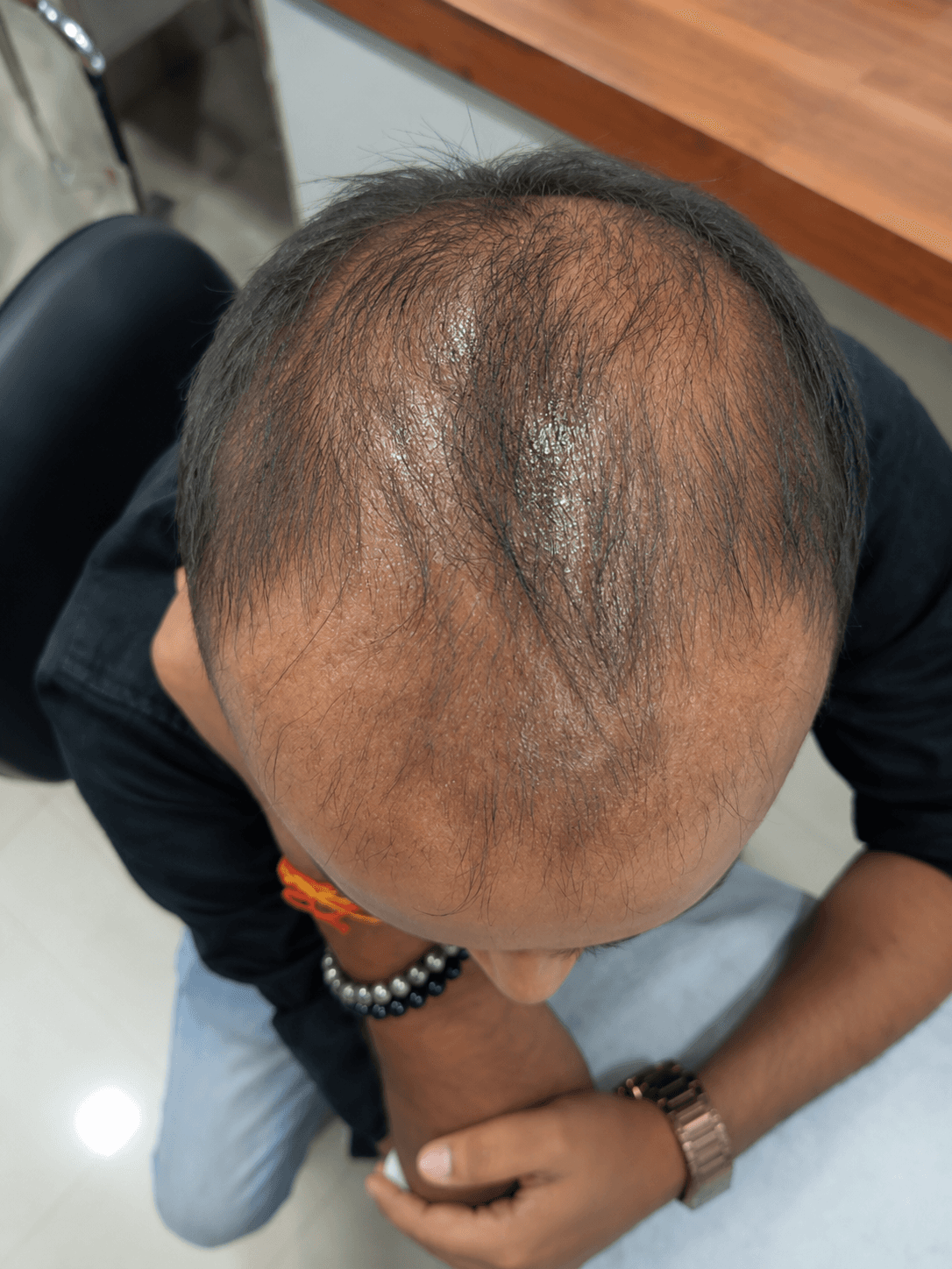 Hair Regrowth — before treatment